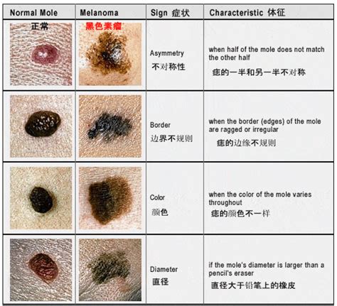 大黑痣|哪些痣会癌变？脸上的痣能点吗？专家这回终于说清楚了